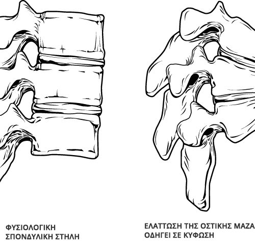 Εικόνα αριστερά με φυσιολογική σπονδυλική στήλη και δεξιά με κύφωση λόγω οστεοπόρωσης
